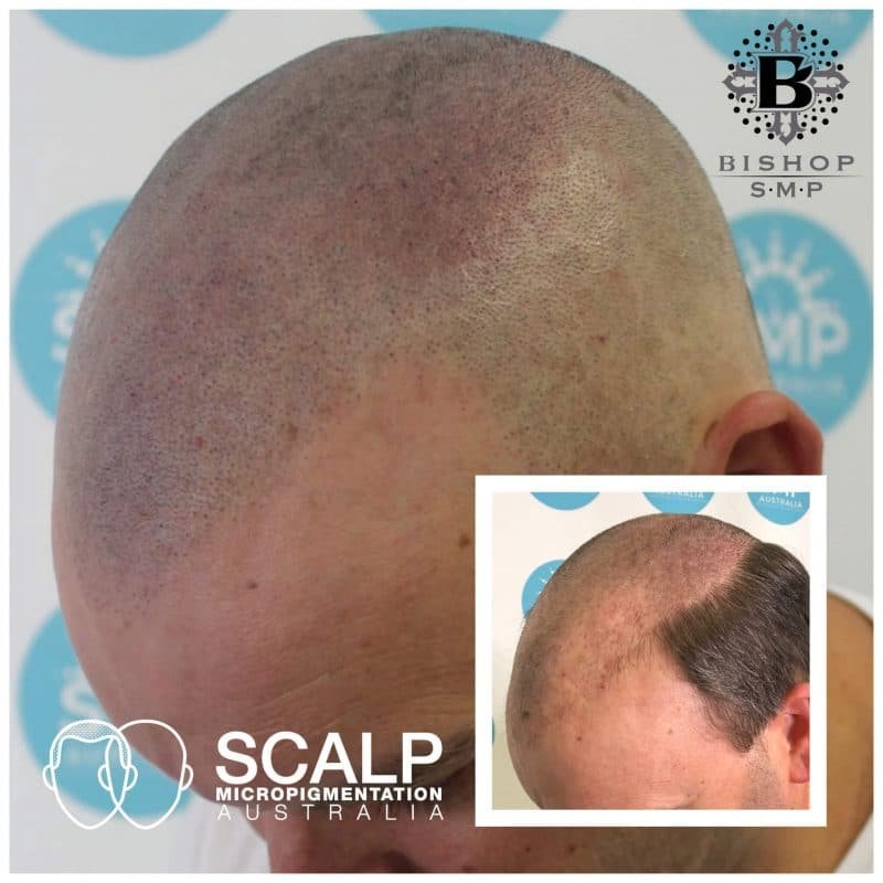 Scalp Micro Pigmentation Australia - Scalp Micro Pigmentation Australia