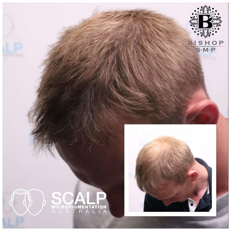 Scalp Micro Pigmentation Australia - Scalp Micro Pigmentation Australia