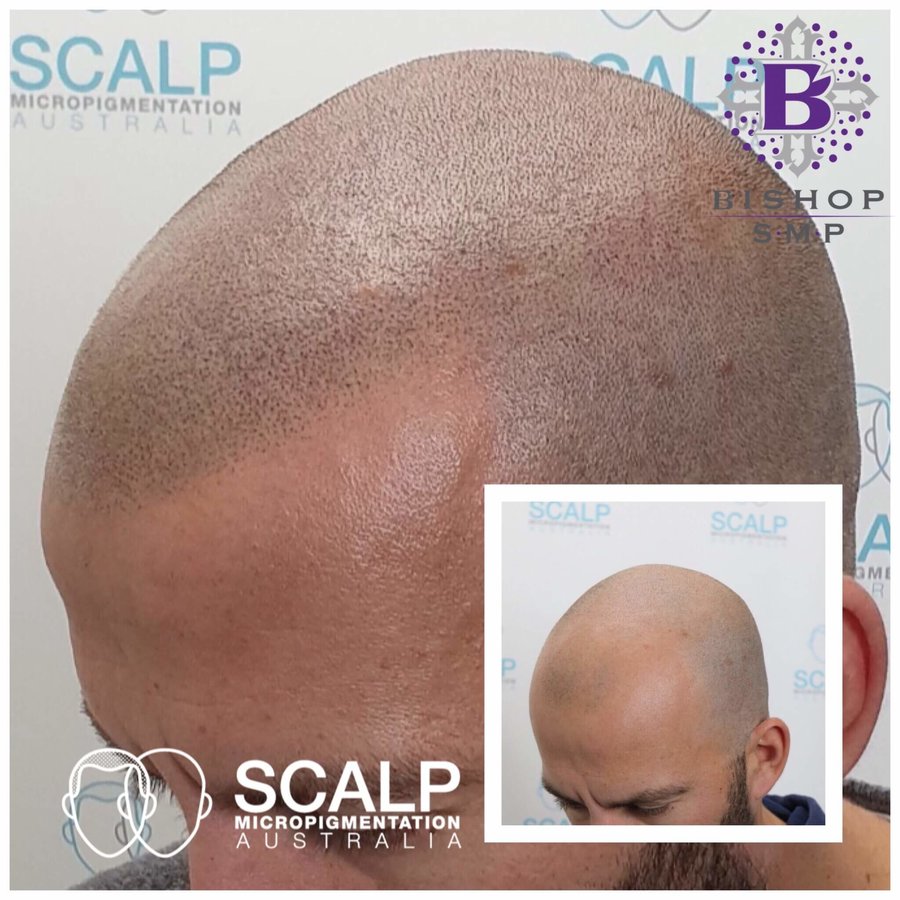 Scalp Micro Pigmentation Australia - Scalp Micro Pigmentation Australia