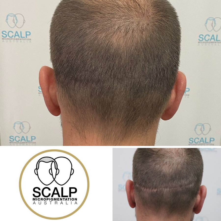 Scalp Micro Pigmentation Australia - Scalp Micro Pigmentation Australia