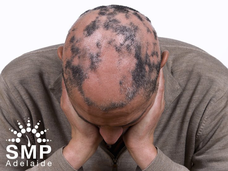 Scalp Micropigmentation Adelaide - Scalp Micropigmentation Adelaide