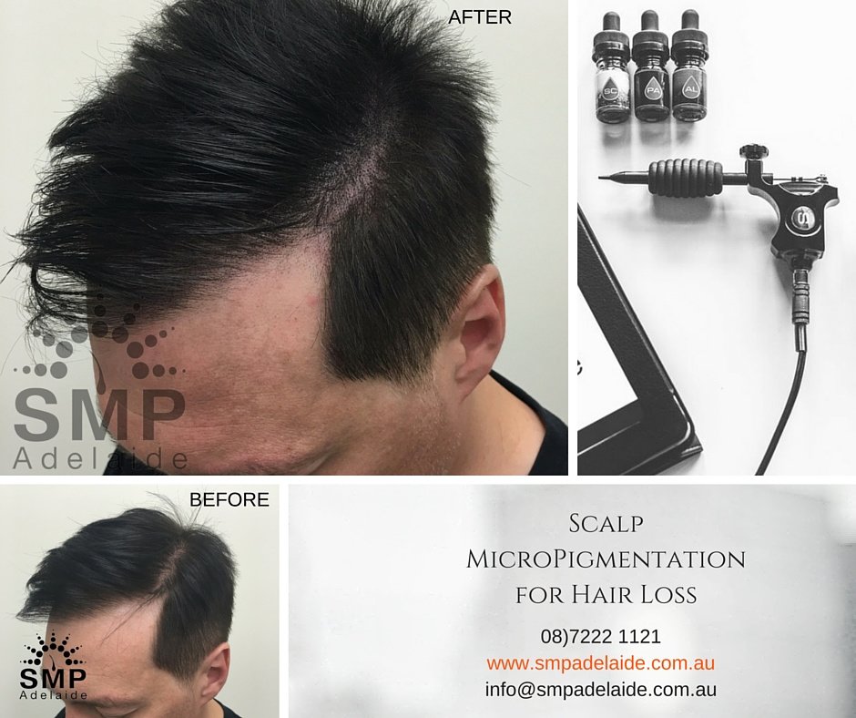 Scalp Micropigmentation Adelaide - Scalp Micropigmentation Adelaide