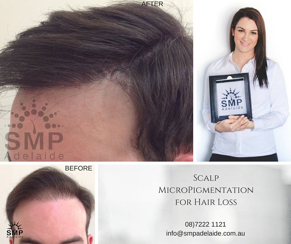 Scalp Micropigmentation Adelaide - Scalp Micropigmentation Adelaide