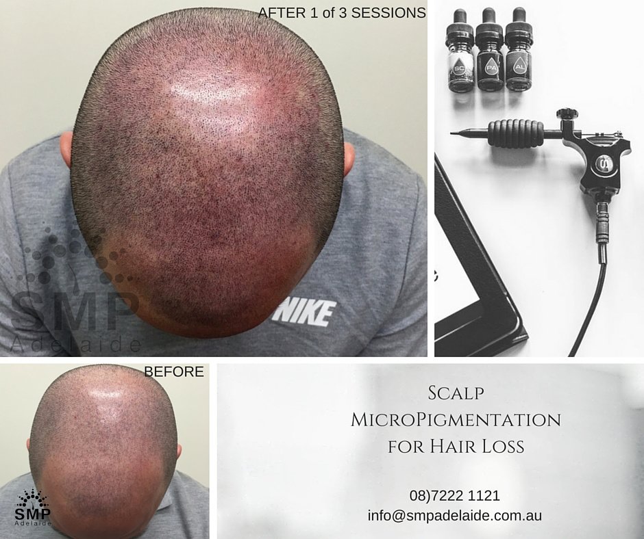Scalp Micropigmentation Adelaide - Scalp Micropigmentation Adelaide