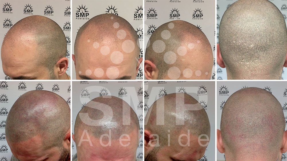Scalp Micropigmentation Adelaide - Scalp Micropigmentation Adelaide
