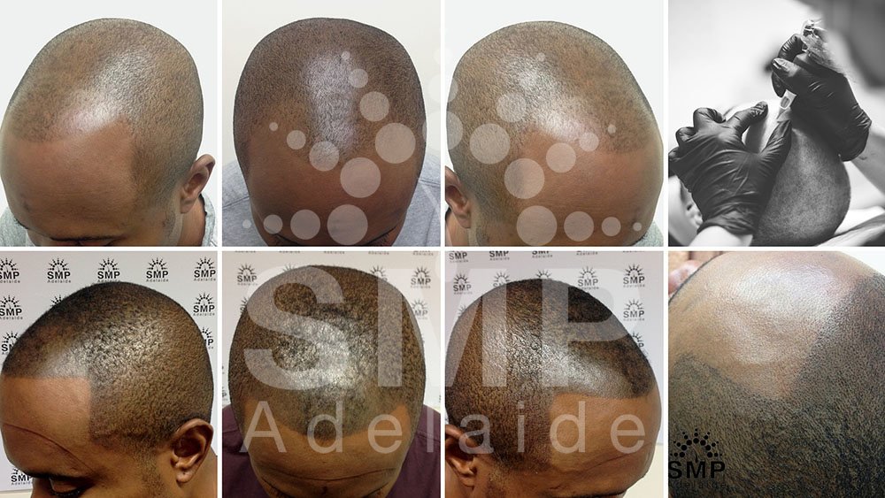Scalp Micropigmentation Adelaide - Scalp Micropigmentation Adelaide