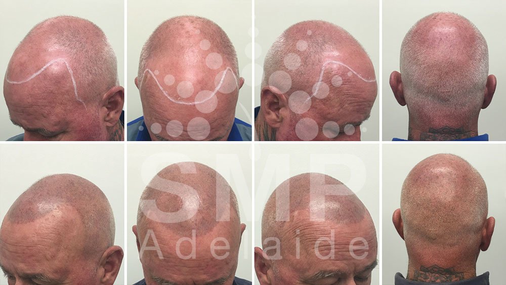 Scalp Micropigmentation Adelaide - Scalp Micropigmentation Adelaide