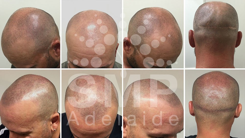 Scalp Micropigmentation Adelaide - Scalp Micropigmentation Adelaide