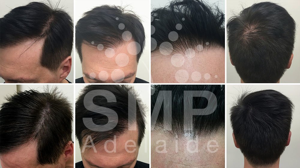 Scalp Micropigmentation Adelaide - Scalp Micropigmentation Adelaide