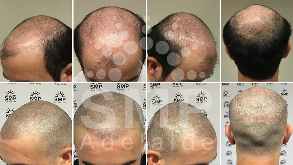 Scalp Micropigmentation Adelaide - Scalp Micropigmentation Adelaide