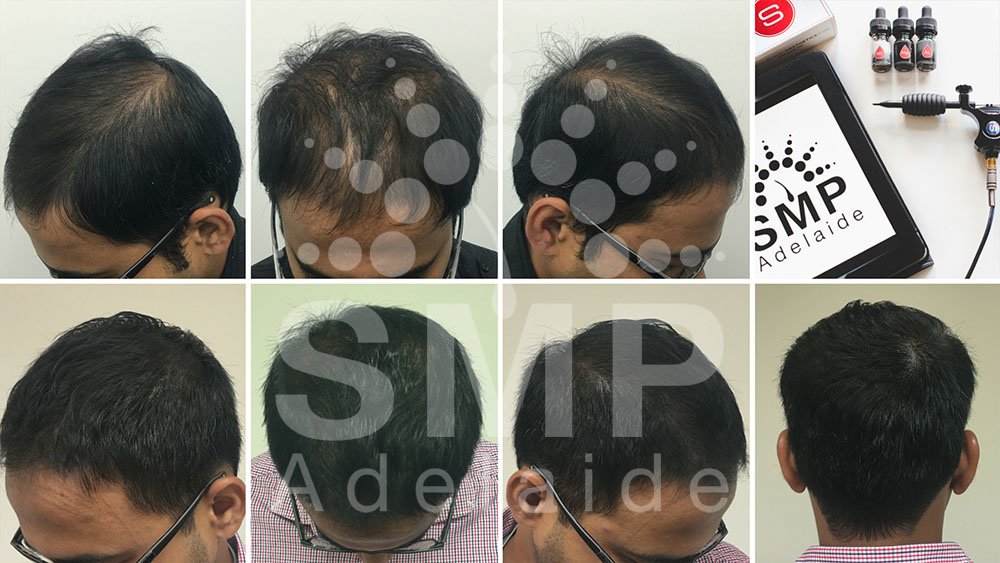Scalp Micropigmentation Adelaide - Scalp Micropigmentation Adelaide