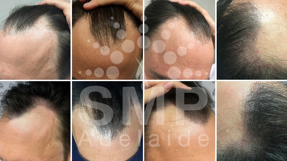Scalp Micropigmentation Adelaide - Scalp Micropigmentation Adelaide
