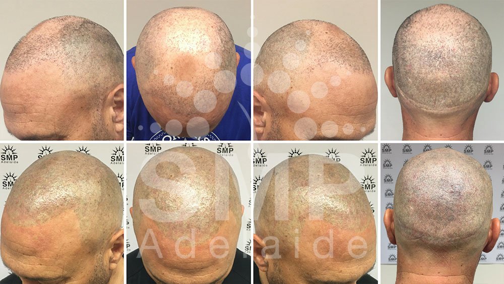 Scalp Micropigmentation Adelaide - Scalp Micropigmentation Adelaide