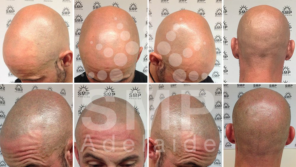 Scalp Micropigmentation Adelaide - Scalp Micropigmentation Adelaide