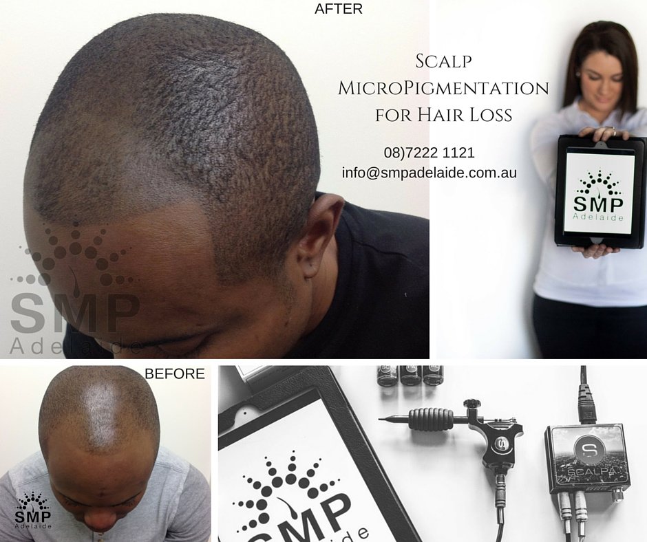 Scalp Micropigmentation Adelaide - Scalp Micropigmentation Adelaide