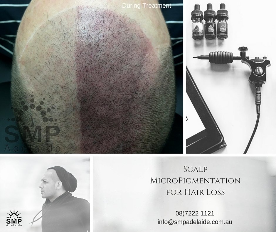 Scalp Micropigmentation Adelaide - Scalp Micropigmentation Adelaide