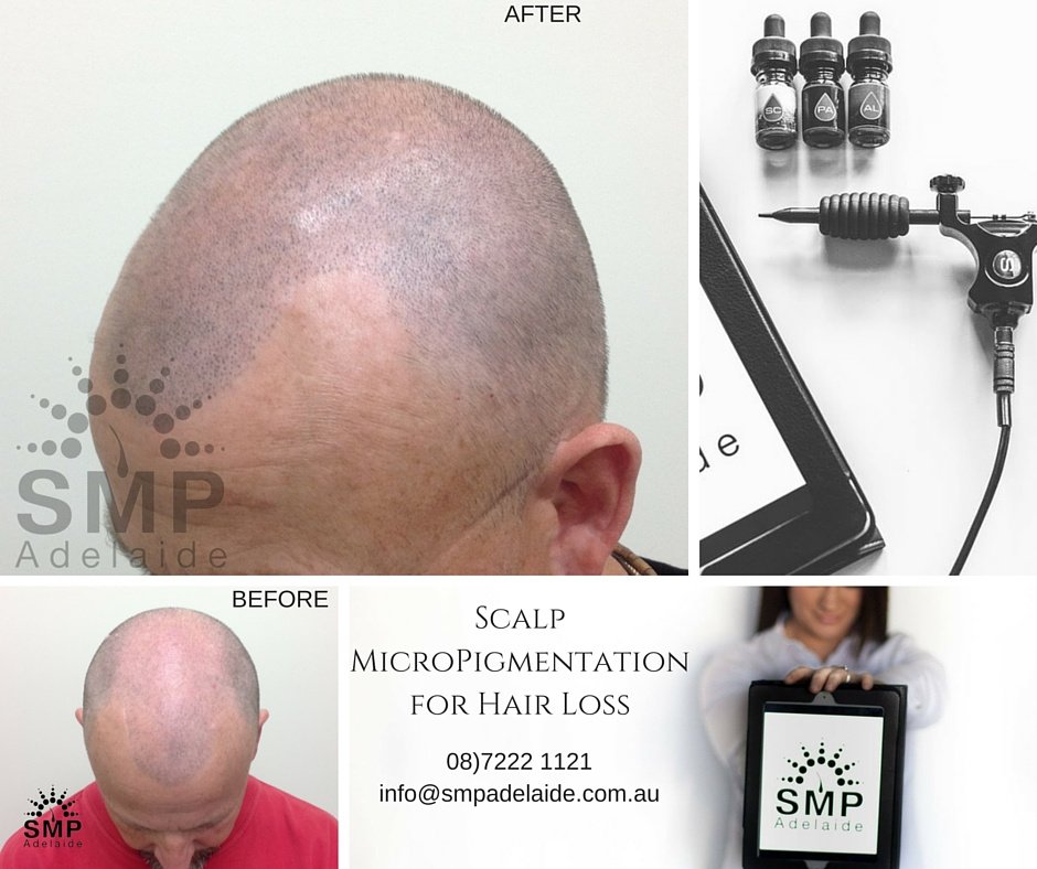 Scalp Micropigmentation Adelaide - Scalp Micropigmentation Adelaide