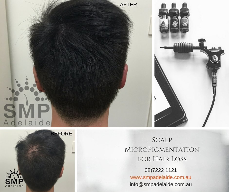 Scalp Micropigmentation Adelaide - Scalp Micropigmentation Adelaide