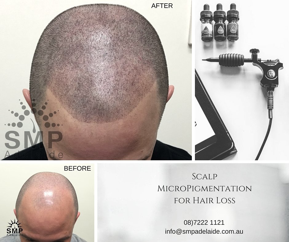 Scalp Micropigmentation Adelaide - Scalp Micropigmentation Adelaide