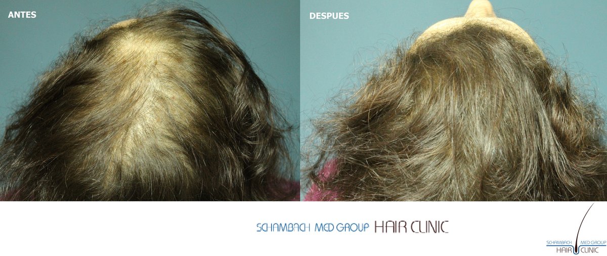 Schambach Medical Hair - Centro Clinico Capilar - Schambach Medical Hair - Centro Clinico Capilar