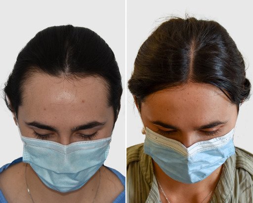 Seneca Hair Transplant - Athens - Seneca Hair Transplant - Athens