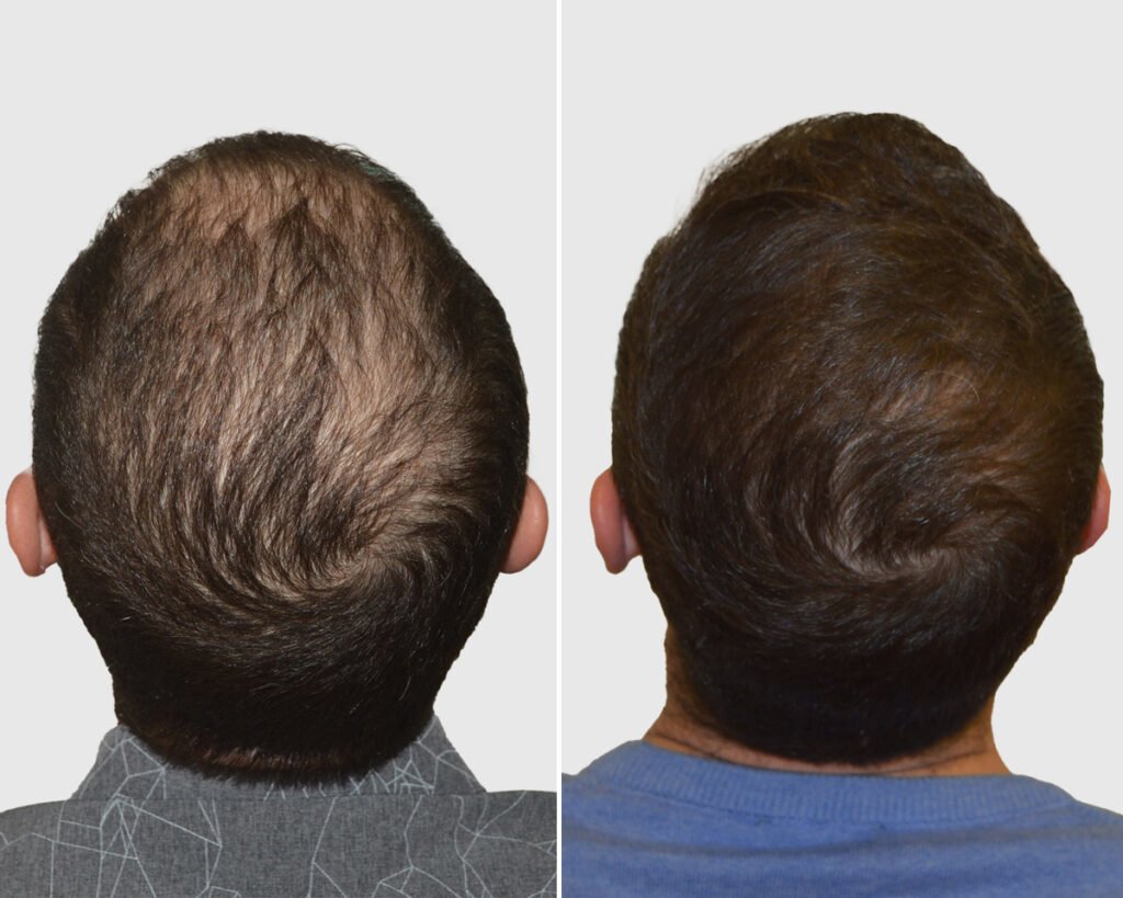 Seneca Hair Transplant - Athens - Seneca Hair Transplant - Athens