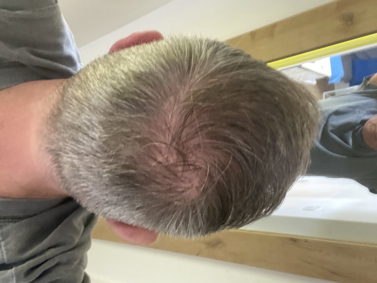 Seneca Hair Transplant - Athens - Seneca Hair Transplant - Athens