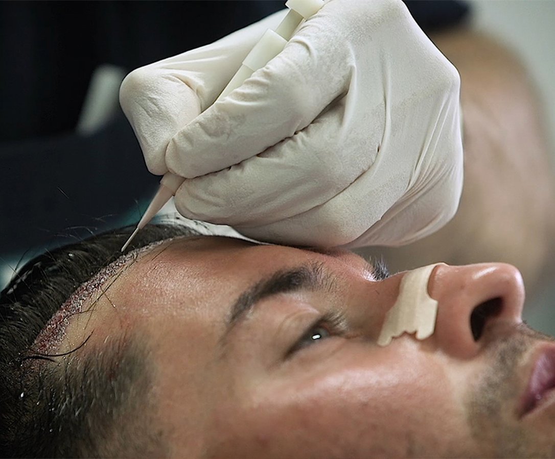 Seneca Hair Transplant - Athens - Seneca Hair Transplant - Athens