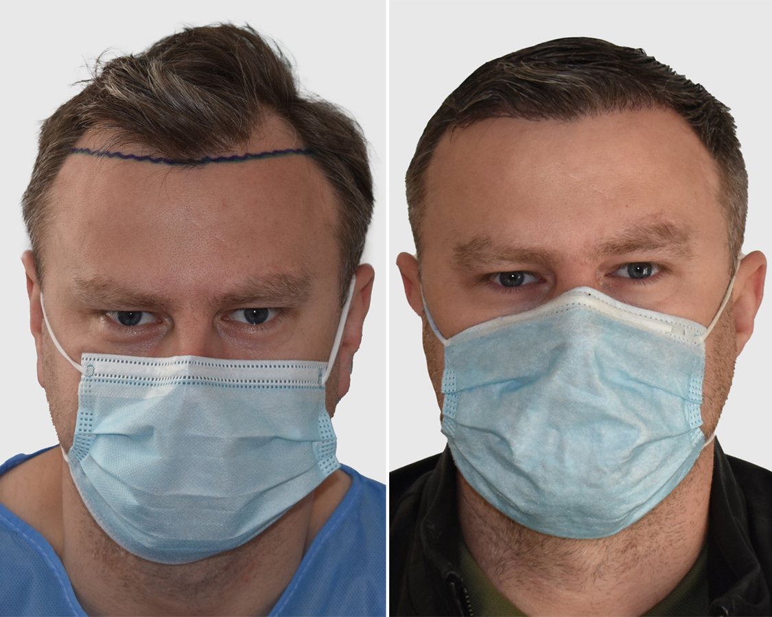 Seneca Hair Transplant - Athens - Seneca Hair Transplant - Athens