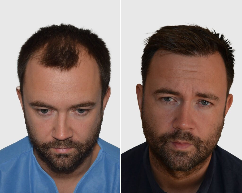 Seneca Hair Transplant - Thessaloniki - Seneca Hair Transplant - Thessaloniki