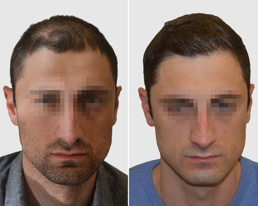 Seneca Hair Transplant - Thessaloniki - Seneca Hair Transplant - Thessaloniki