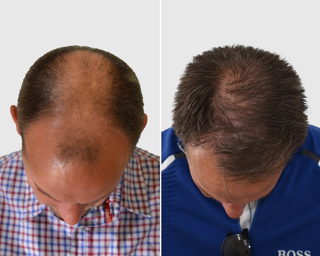 Seneca Hair Transplant - Thessaloniki - Seneca Hair Transplant - Thessaloniki