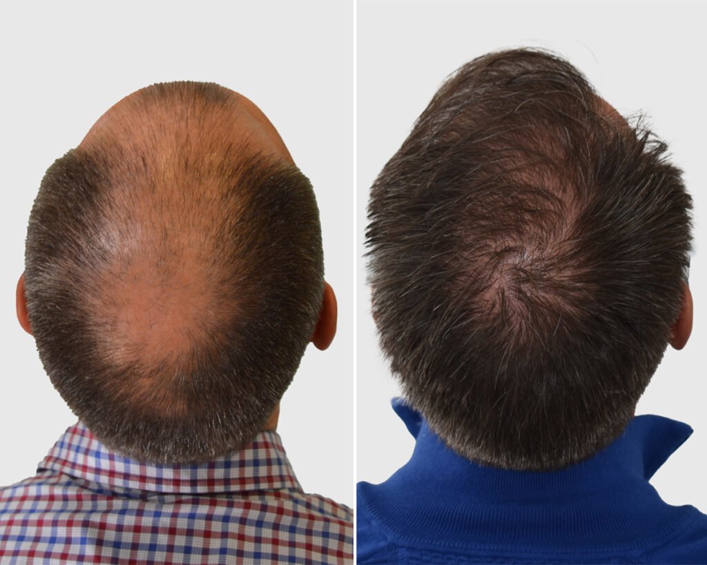 Seneca Hair Transplant - Thessaloniki - Seneca Hair Transplant - Thessaloniki