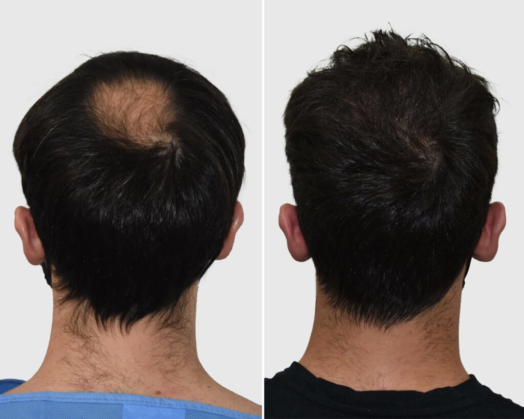 Seneca Hair Transplant - Thessaloniki - Seneca Hair Transplant - Thessaloniki