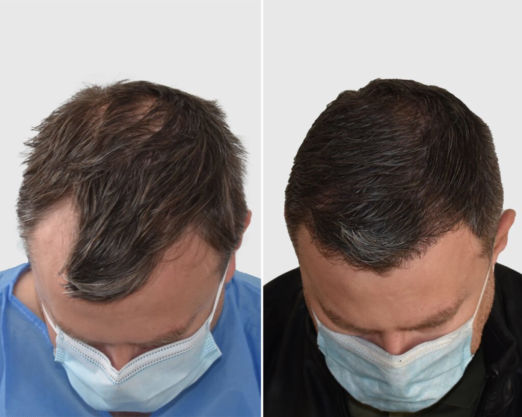Seneca Hair Transplant - Thessaloniki - Seneca Hair Transplant - Thessaloniki