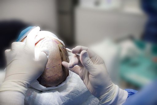 Seneca Hair Transplant - Thessaloniki - Seneca Hair Transplant - Thessaloniki