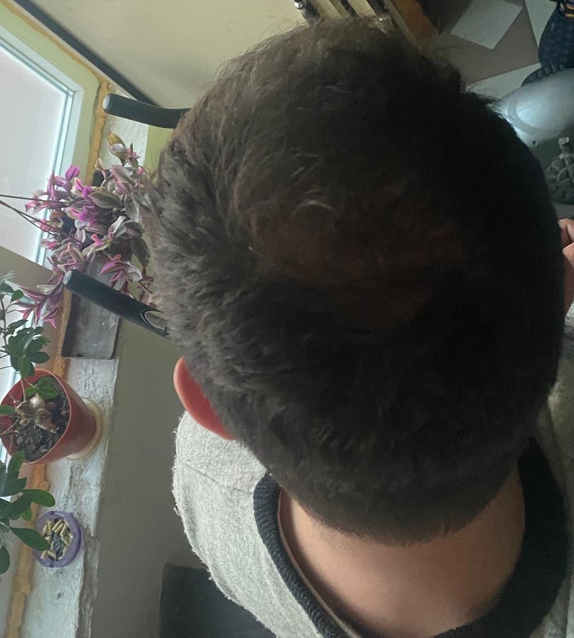 Seneca Hair Transplant - Thessaloniki - Seneca Hair Transplant - Thessaloniki