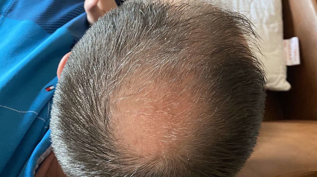 Seneca Hair Transplant - Thessaloniki - Seneca Hair Transplant - Thessaloniki