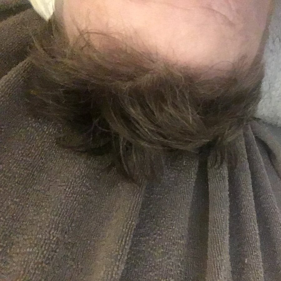 Seneca Hair Transplant - Thessaloniki - Seneca Hair Transplant - Thessaloniki