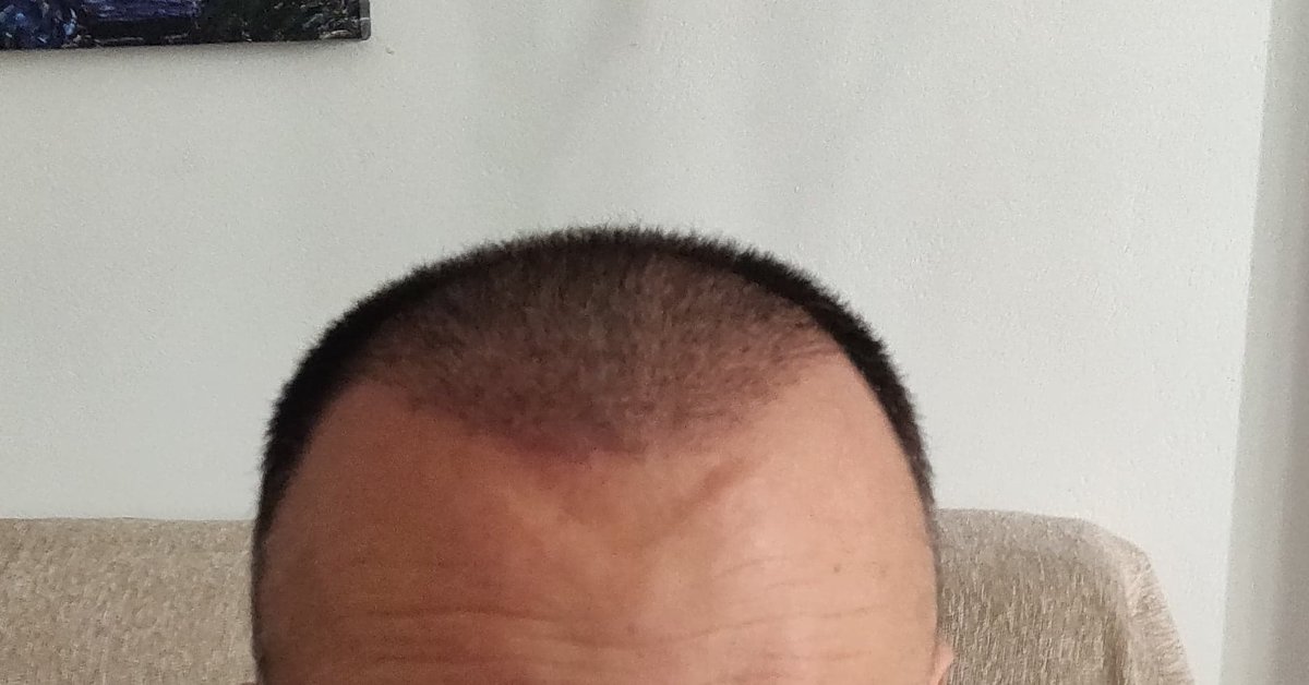 Seneca Hair Transplant - Thessaloniki - Seneca Hair Transplant - Thessaloniki