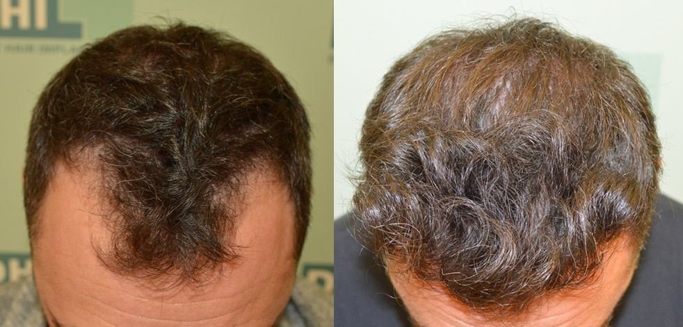 Seneca Hair Transplant - Thessaloniki - Seneca Hair Transplant - Thessaloniki