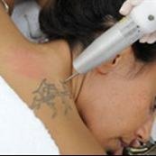 Silkor Laser Hair Removal - Waab - Silkor Laser Hair Removal - Waab