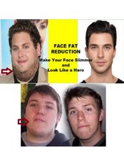 أنيق الدب : علاج الحد من الدهون الوجه - Sleek Bear : Face Fat Reduction Treatment