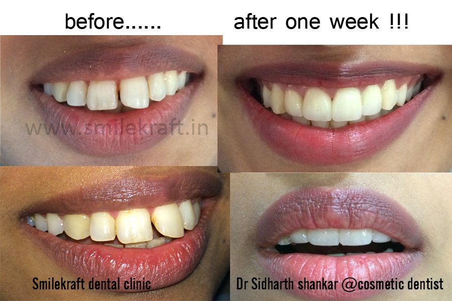Smilekraft Dental Clinic, Bangalore - Smilekraft Dental Clinic, Bangalore