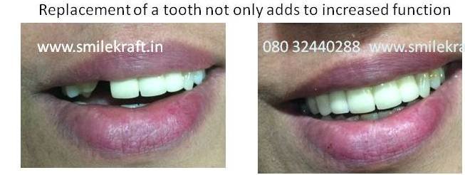Smilekraft Dental Clinic, Bangalore - Smilekraft Dental Clinic, Bangalore