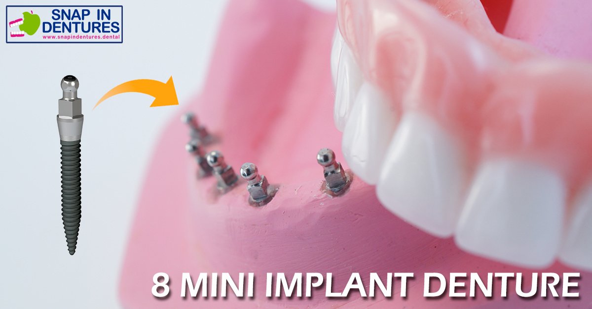 Snap In Dentures - Snap In Dentures