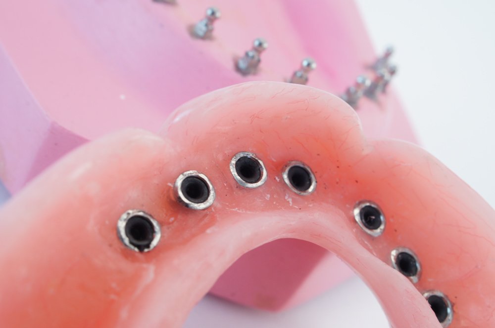 Snap In Dentures - Snap In Dentures