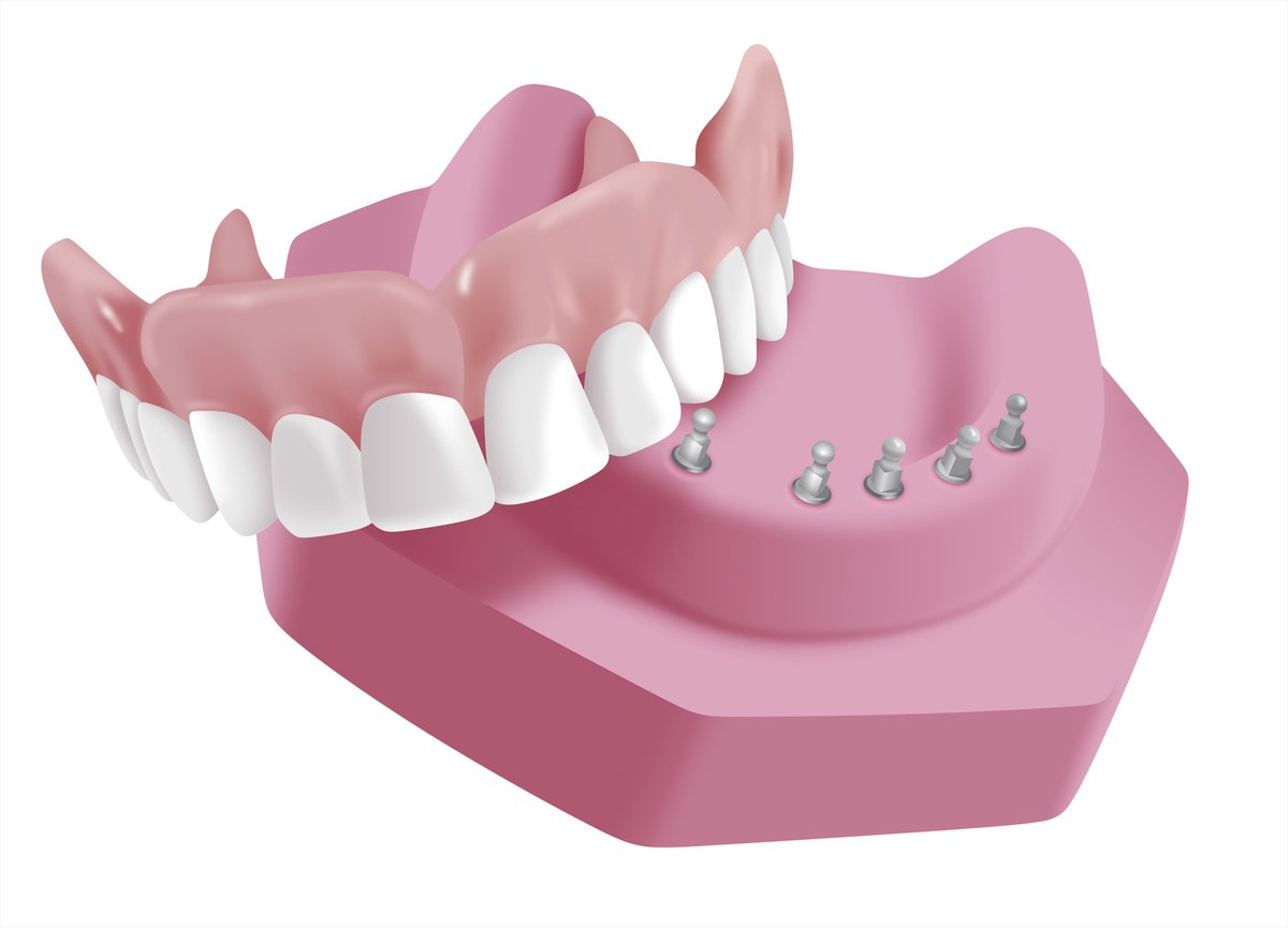 Snap In Dentures - Snap In Dentures