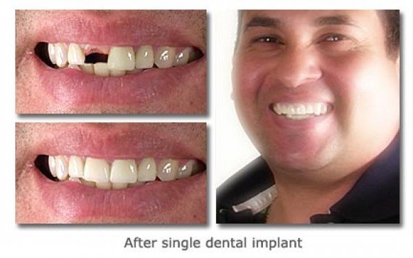South Tampa Dentists - Ed Francisco DDS - South Tampa Dentists - Ed Francisco DDS