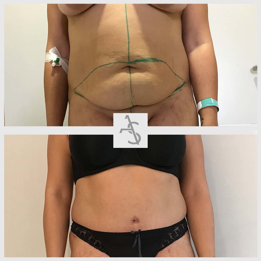 Strevinas Plastic Surgery - Strevinas Plastic Surgery